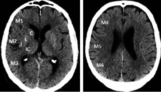 2017急性缺血性卒中血管内治疗影像评估中国专家共识