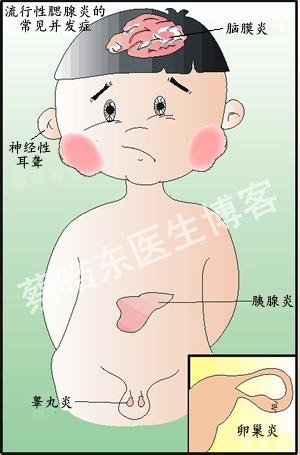 如何预防幼儿流行性腮腺炎,流行性腮腺炎的预防措施