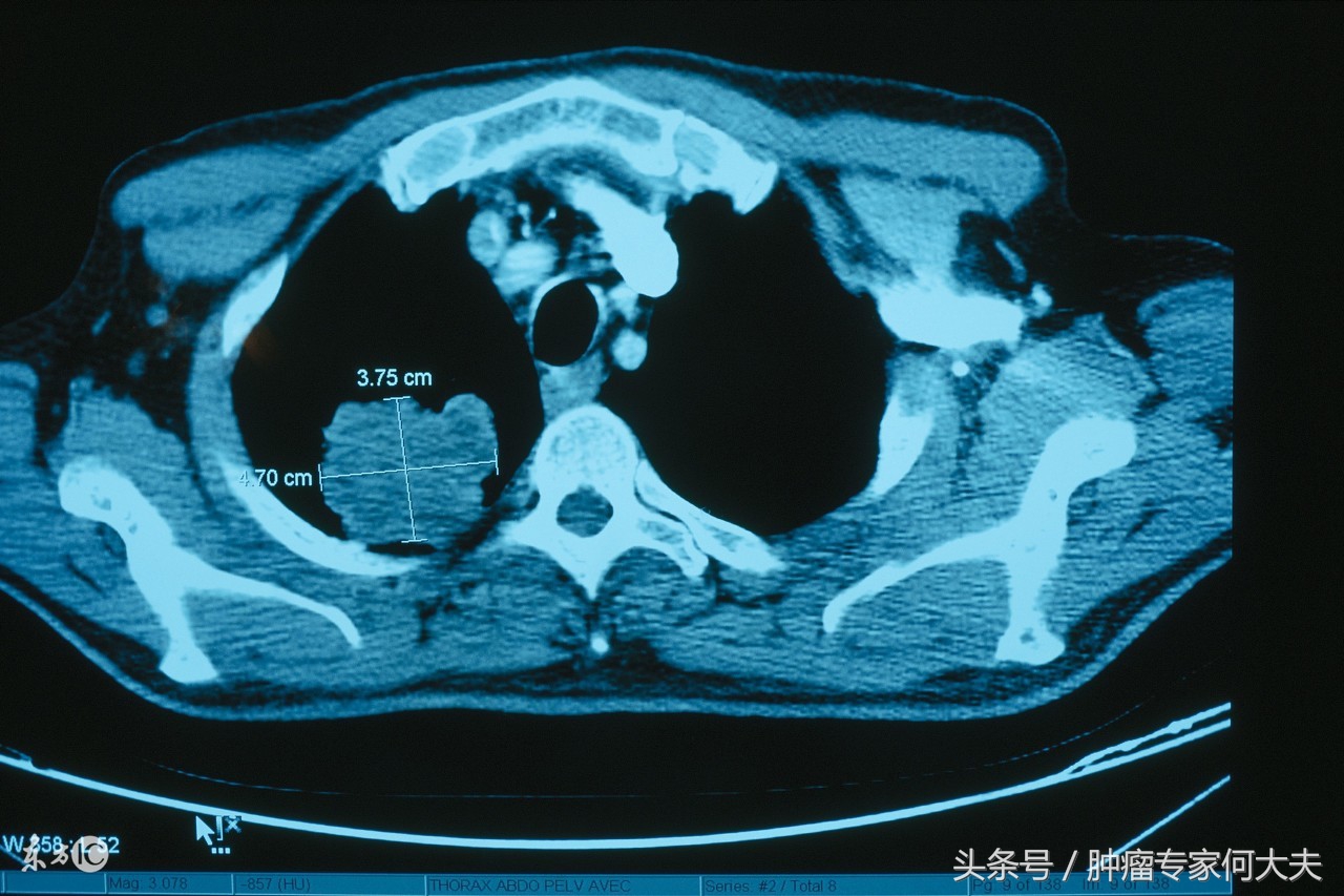 癌症漏诊,癌症被漏诊