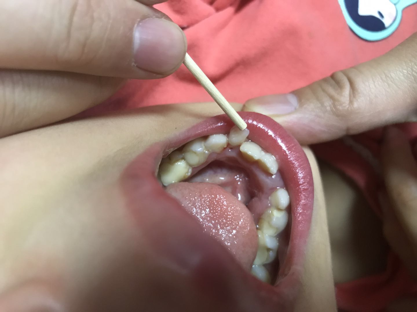 小朋友掉了牙齿牙龈有点肿,女儿7岁了门牙掉了牙床红肿