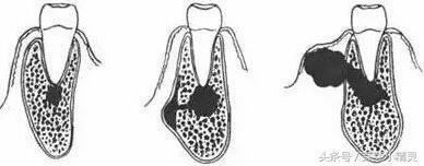 牙龈处长了不疼的小包,牙龈上起了一个小肉包的图片