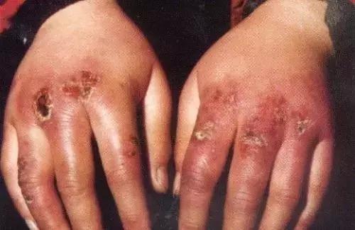 冻疮有特效膏药吗,治冻疮最快的药方