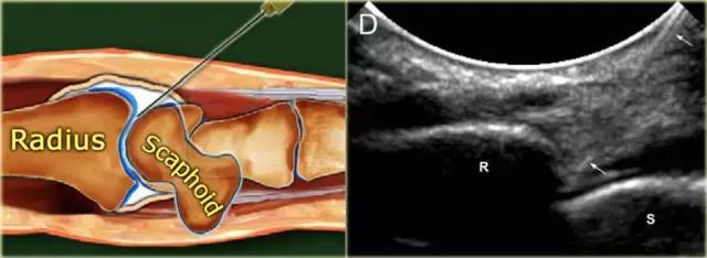 超声引导下穿刺手法解析,超声介入穿刺和普通穿刺的区别
