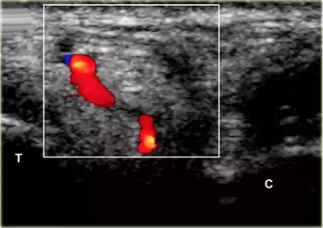 超声引导下穿刺手法解析,超声介入穿刺和普通穿刺的区别