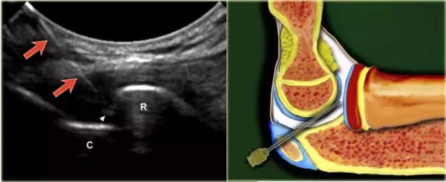 超声引导下穿刺手法解析,超声介入穿刺和普通穿刺的区别