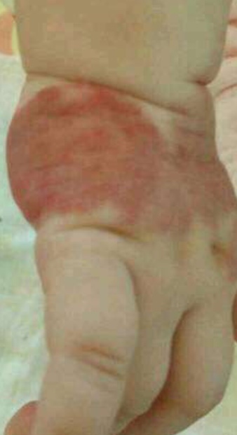 宝妈胎记,胎记你们的宝宝有吗