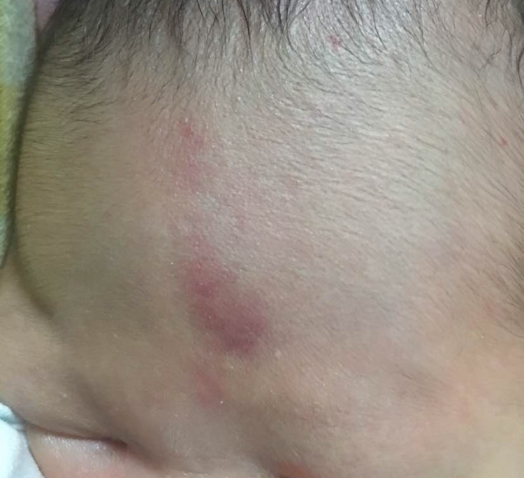 宝妈胎记,胎记你们的宝宝有吗