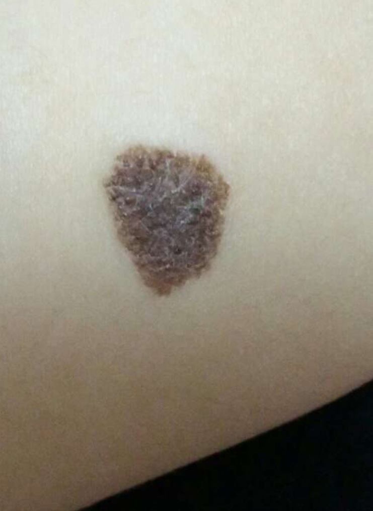 宝妈胎记,胎记你们的宝宝有吗