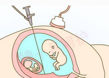 产前疾病筛查是查什么病,产前筛查介绍