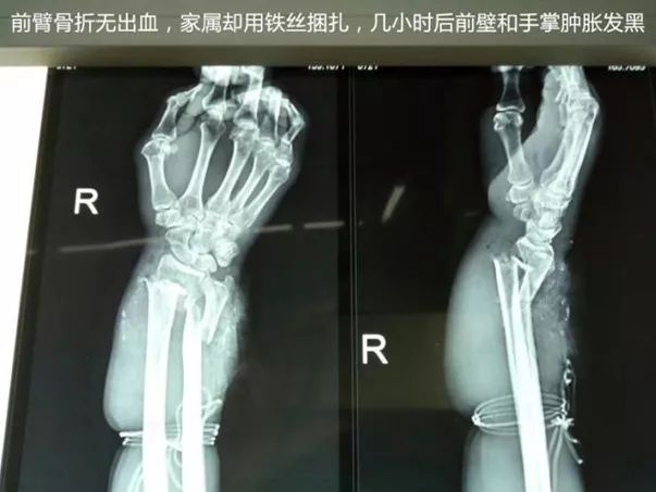 伤口出血可以用卫生巾止血吗,伤口出血怎么包扎好