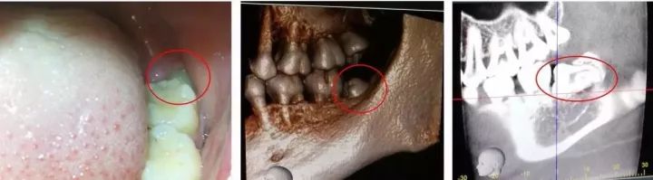 智齿拔牙后恢复的亲身经历,拔牙后感染是什么样的症状啊