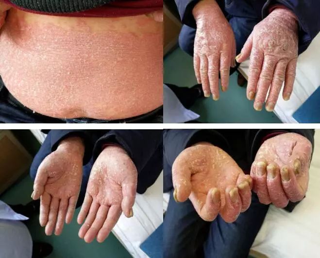 简单有效的银屑病偏方,中药泡浴治银屑病最好吗