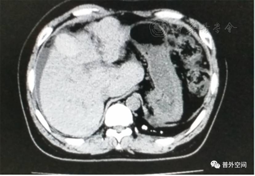 肝炎后失代偿期肝硬化的治疗与手术技巧
