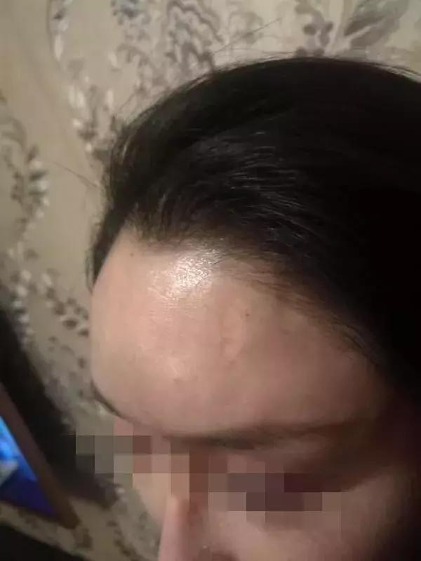 额头被别人砸了一道口子赔偿,额头被人砸开留疤能赔多少