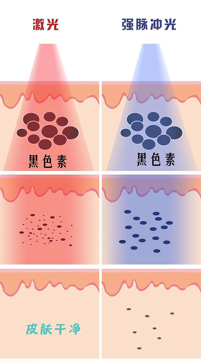 表皮部位色素治疗——遇到雀斑怎么办