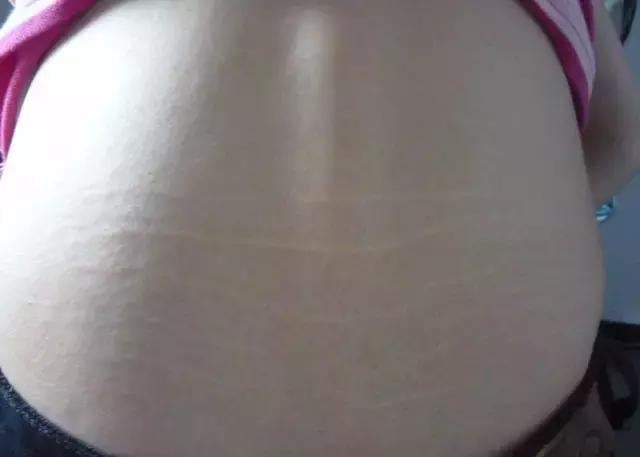 背后有肾虚纹,有肾虚纹