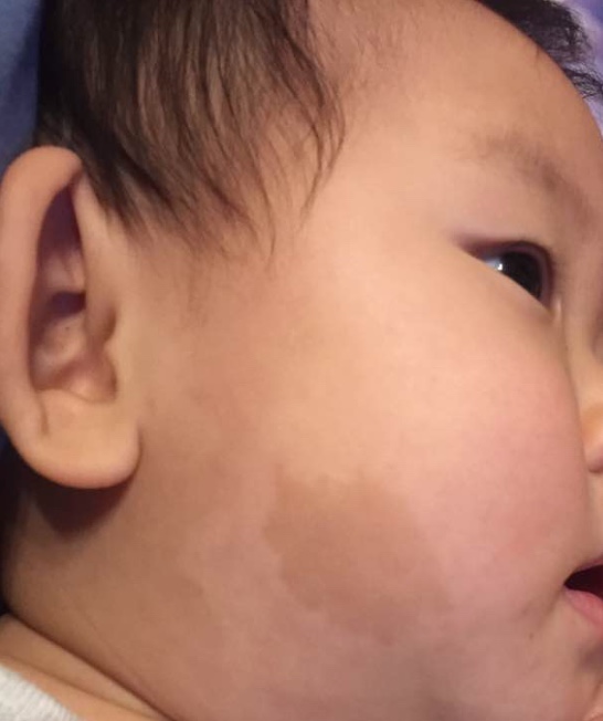 宝妈胎记,胎记你们的宝宝有吗