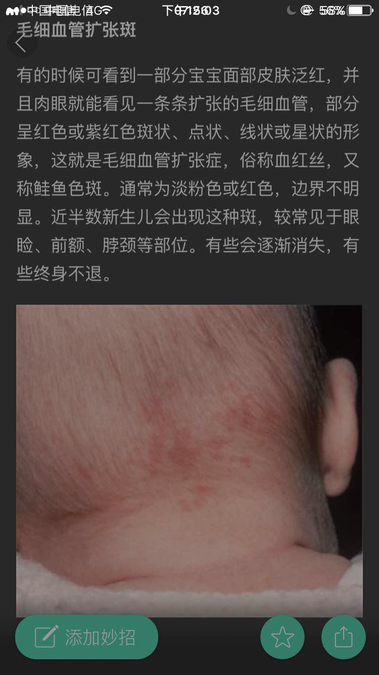 宝妈胎记,胎记你们的宝宝有吗