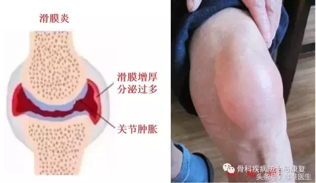 滑膜炎深度讲解（一）——华中科技大学附属协和骨科医院专家
