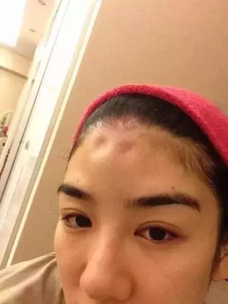 额头被别人砸了一道口子赔偿,额头被人砸开留疤能赔多少