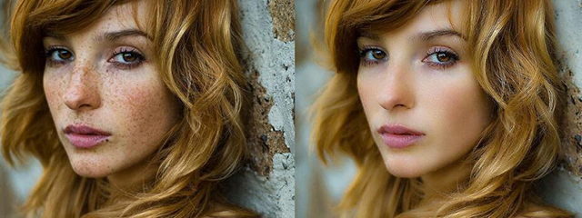 表皮部位色素治疗——遇到雀斑怎么办