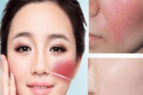 天生脸部泛红怎么改善红血丝特多,血丝脸怎么治疗