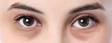 拯救熬夜肌淡化黑眼圈,黑眼圈护理