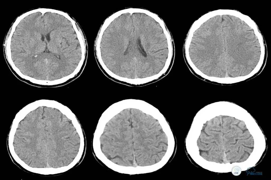 主动脉夹层引起的脑梗后遗症,颈动脉狭窄缺血性脑梗