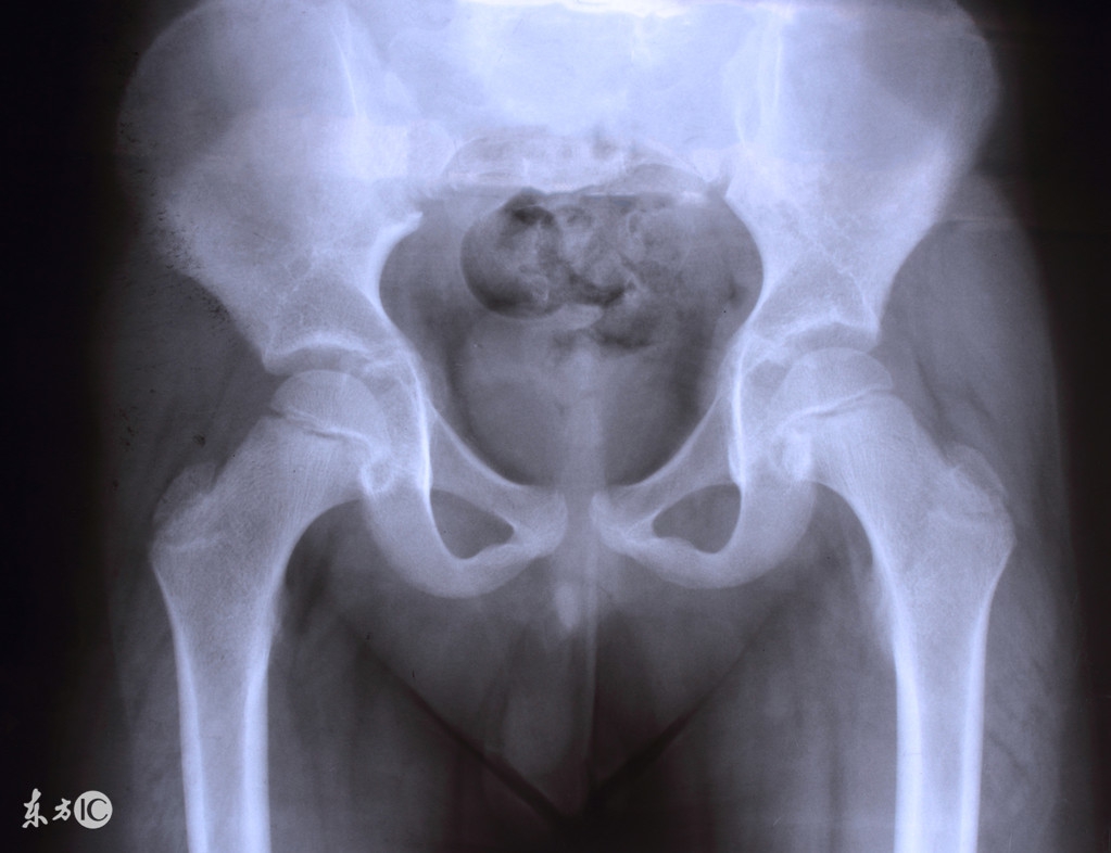 女性盆腔积液，了解病因，做好预防