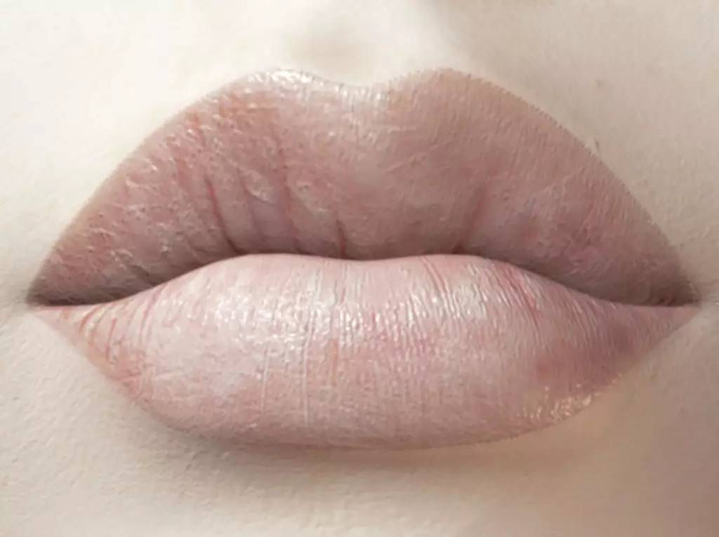 一个肺病患者的自白,唇炎患者自述