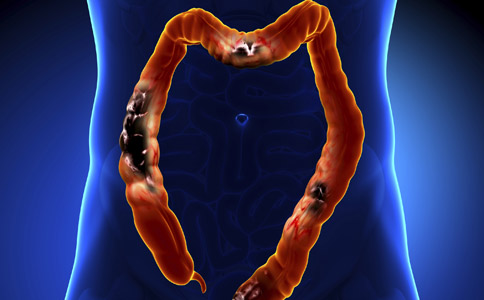 不可忽视的风险有哪些,不可轻视的肝损害免疫性肝炎