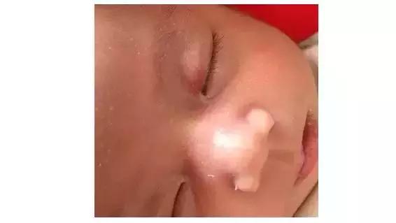 宝宝身上隐藏的“胎记”，你或许还没有发现