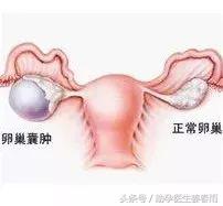 卵巢囊肿的同胞,卵巢囊肿有忌口的吗