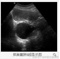 卵巢囊肿的同胞,卵巢囊肿有忌口的吗