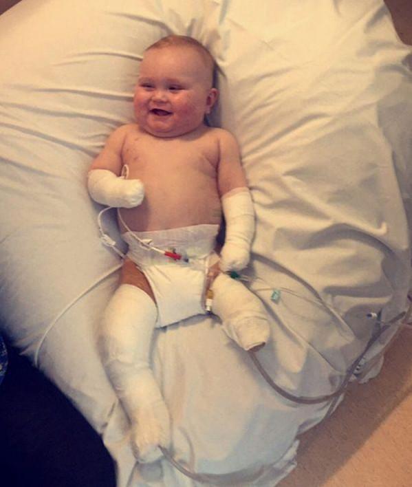 因为买衣服，10个月宝宝咳嗽发烧造成手部和腿截肢，宝妈赶快避免