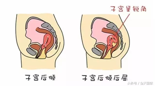 怎么会导致子宫移位的,子宫移位是怎么造成的