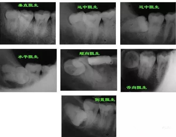 智齿长歪了把邻牙挤坏了,智齿挤歪了会自己恢复吗