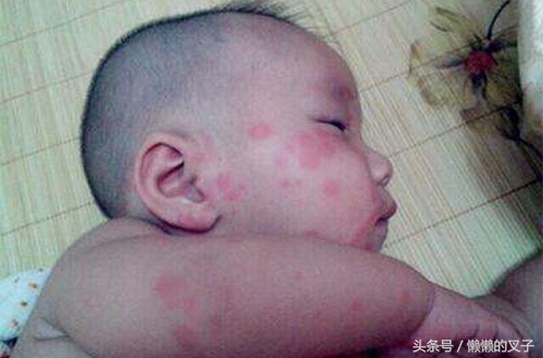 麻疹止痒有没有什么草药治疗,荨麻疹止痒小妙招是什么