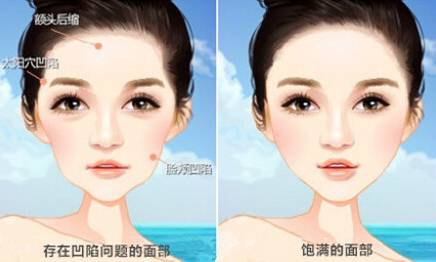 首尔自体脂肪填充,哪些明星做了自体脂肪填充