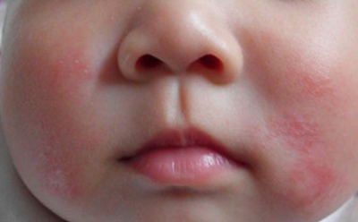 引起宝宝湿疹的原因和解决方案,宝宝容易长湿疹妈妈应该关注什么