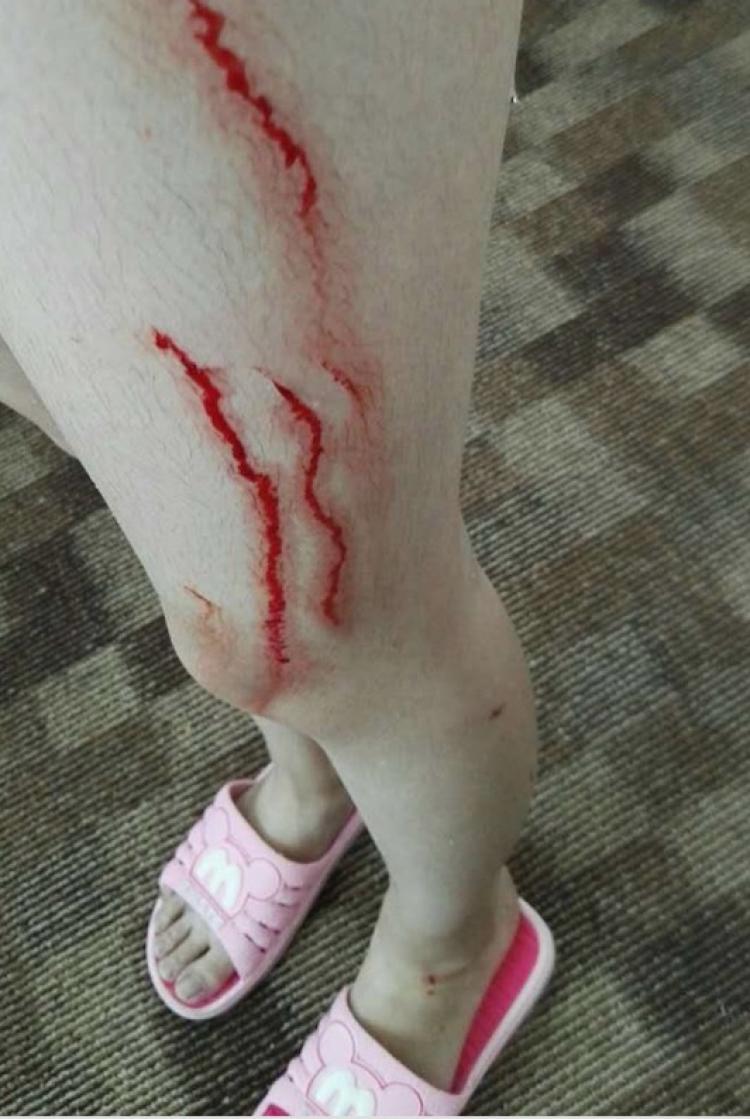 现在打架斗殴怎么解决,打架脸肿起来大包怎么办