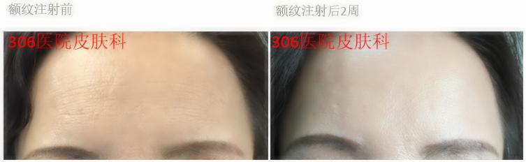 国家认可瘦脸针,军医扎针