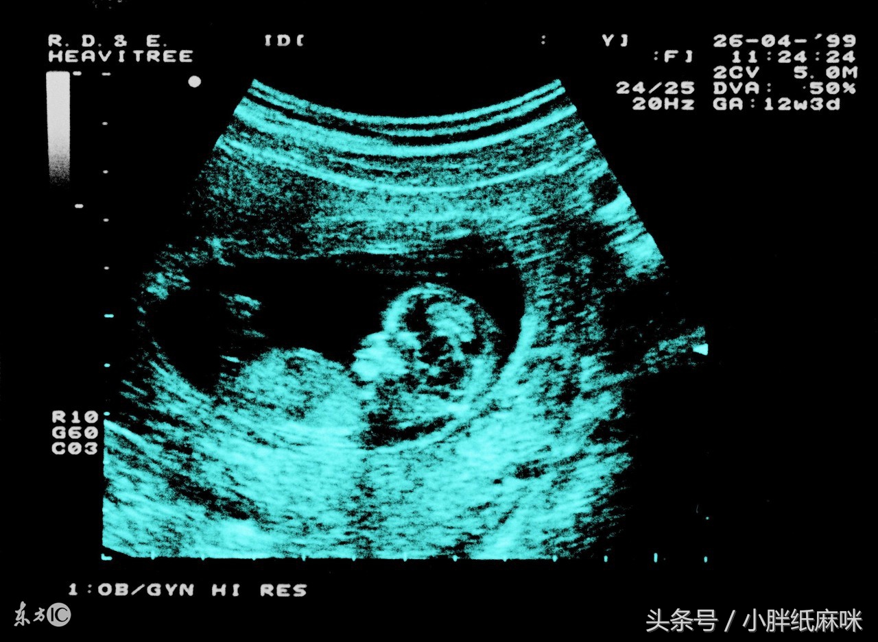 孕妇引产后胎儿奇迹存活,怀孕8个月引产胎儿怎么处理