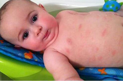 引起宝宝湿疹的原因和解决方案,宝宝容易长湿疹妈妈应该关注什么