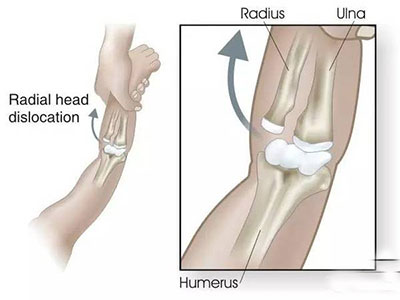 孩子爸爸拽孩子胳膊,爸爸拽孩子脱臼