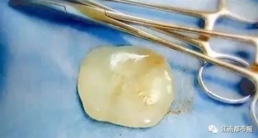 全球仅有10几例，宝宝带“玉”出生！原来是因为……