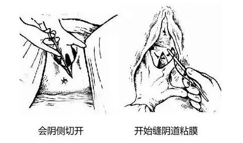 生孩子，你需要做会阴侧切么？
