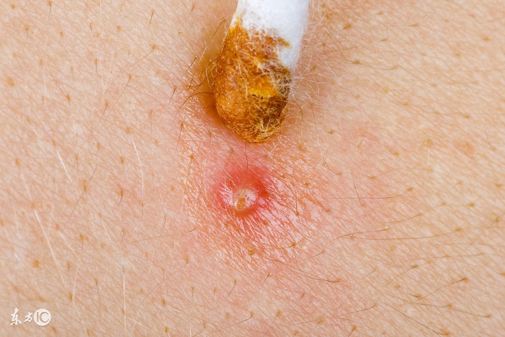 毛囊炎怎么护理头发,毛囊炎护理措施有哪些