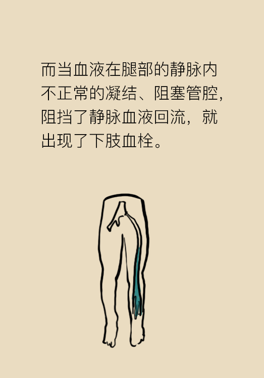 压力袜穿久了没脱,压力袜穿起来很紧还能穿吗