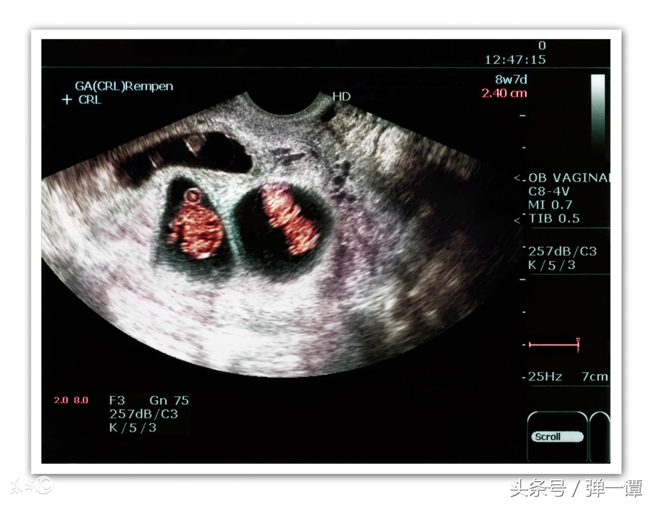产妇顺产后一周肚子发硬,产妇刚生完肚子咕咕响